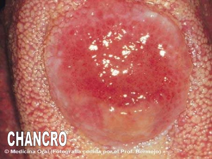 Me Sale Pus Del Pene Enfermedades Venereas