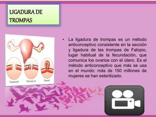 LIGADURA DE 
TROMPAS 
• La ligadura de trompas es un método 
anticonceptivo consistente en la sección 
y ligadura de las trompas de Falopio, 
lugar habitual de la fecundación, que 
comunica los ovarios con el útero. Es el 
método anticonceptivo que más se usa 
en el mundo: más de 150 millones de 
mujeres se han esterilizado. 
 