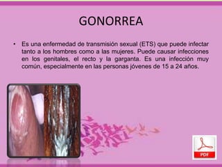GONORREA 
• Es una enfermedad de transmisión sexual (ETS) que puede infectar 
tanto a los hombres como a las mujeres. Puede causar infecciones 
en los genitales, el recto y la garganta. Es una infección muy 
común, especialmente en las personas jóvenes de 15 a 24 años. 
 