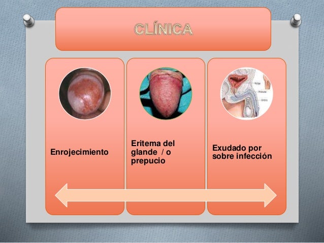 La aplicación de los ungüentos a la eccema