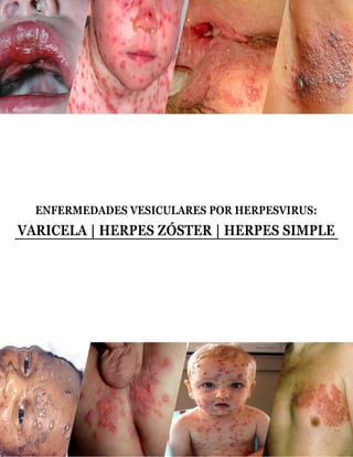 ENFERMEDADES VESICULARES POR HERPESVIRUS:
VARICELA | HERPES ZÓSTER | HERPES SIMPLE
 