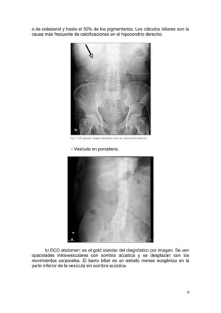 o de colesterol y hasta el 50% de los pigmentarios. Los cálculos biliares son la
causa más frecuente de calcificaciones en el hipocondrio derecho.




                    - Vesícula en porcelana.




       b) ECO abdomen: es el gold standar del diagnóstico por imagen. Se ven
opacidades intravesiculares con sombra acústica y se desplazan con los
movimientos corporales. El barro biliar es un estrato menos ecogénico en la
parte inferior de la vesícula sin sombra acústica.




                                                                               6
 