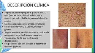 DESCRIPCIÓN CLÍNICA
• Se presenta como pequeñas pápulas de 1-2
mm (hasta 8 mm), del color de la piel y
aspecto perlado y brillante, con umbilicación
central
• Las lesiones pueden ser únicas o múltiples
• Lesiones en la vulva, la vagina, muslos y
glúteos
• Se pueden observas abscesos secundarios a la
manipulación de las lesiones y eccema
• Transmisible hasta que las lesiones
desaparezcan
• Los pacientes con VIH tienden a desarrollar
lesiones gigantes
 