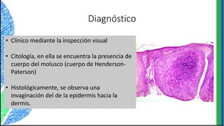 Diagnóstico
• Clínico mediante la inspección visual
• Citología, en ella se encuentra la presencia de
cuerpo del molusco (cuerpo de Henderson-
Paterson)
• Histológicamente, se observa una
invaginación del de la epidermis hacia la
dermis.
 