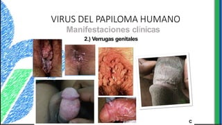 VIRUS DEL PAPILOMA HUMANO
Manifestaciones clínicas
2.) Verrugas genitales
VPosierrugasbles
ubicgenitalesacioneexs: t
e
r
n
a
s
pued•
P
e
r
e
n
i
n
é
s
e
r
,alrpledanedoras,cdeupulifl
ano
ormes
(sin ,
queratnecesiósidadcas,depecodiitculo
adanasal)yen
f
o
•Vrmaaginadecoliflor
• Uretra
De
•
Ár
pe
eas
ndi
c
end
ervi
o
ca
de
les,
tama
intrav
ñoagi
pued
na
le
en
se ser
intra
pruriginosas,
-anales
(requie
causar
re co
sensaci
ito an
ón
al) C
 