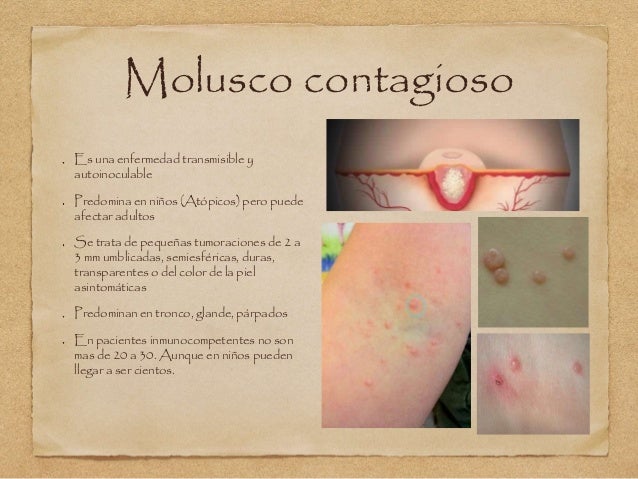 enfermedad sexualmente transmisible enfermedad sexualmente transmisible