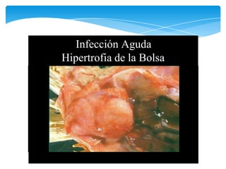 Infección Aguda
Hipertrofia de la Bolsa
 