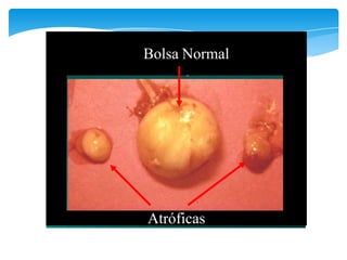 Atróficas
Bolsa Normal
 