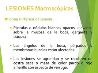  Pústulas o nódulos blancos opacos, elevados
sobre la mucosa de la boca, garganta y
tráquea.
 Los ángulos de la boca, párpados y
membranas bucales están afectadas.
 Las lesiones se agrandan y se recubren de
costra seca o masa de color pardo o rojo
amarillo con aspecto de verruga.
Forma Diftérica o Húmeda
 