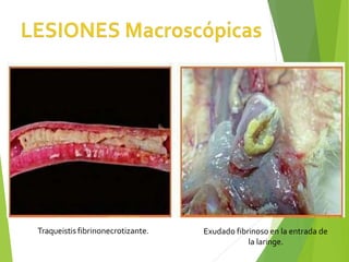 Traqueistis fibrinonecrotizante. Exudado fibrinoso en la entrada de
la laringe.
 