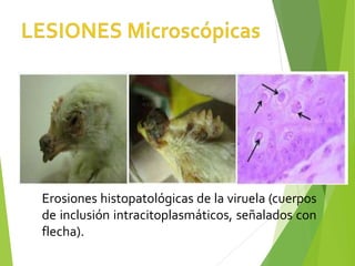 Erosiones histopatológicas de la viruela (cuerpos
de inclusión intracitoplasmáticos, señalados con
flecha).
 