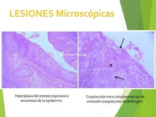 Hiperplasia del estrato espinoso o
escamoso de la epidermis.
Corpúsculos intra citoplasmaticos de
inclusión (corpúsculos de Bollinger).
 