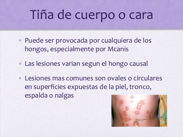 Quien ha sanado el hongo de los pie el foro