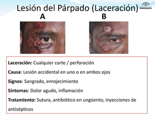 Lesión del Párpado (Laceración)
Laceración: Cualquier corte / perforación
Causa: Lesión accidental en uno o en ambos ojos
...