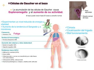 +

Células de Gaucher en el bazo


La acumulación de las células de Gaucher causa

Esplenomegalia y el aumento de su actividad.
El bazo puede crecer hasta 25 veces su tamaño normal.

Experimentan un nivel reducido de energía y
vitalidad.
Aumento de la tendencia al Sangrado y a
moretones

Fatiga

Cirrosis
Cicatrización del hígado
Mal funcionamiento

 