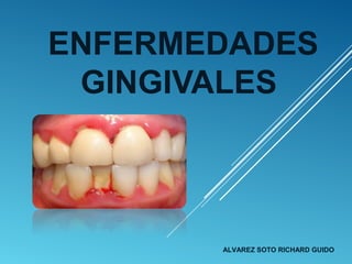 ENFERMEDADES
GINGIVALES
ALVAREZ SOTO RICHARD GUIDO
 