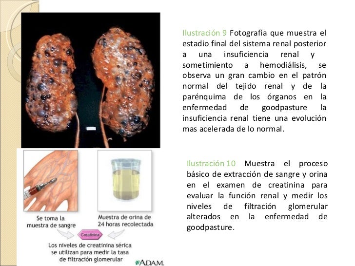 ENFERMEDAD DE GOODPASTURE PDF