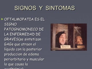 SIGNOS Y SINTOMAS
► OFTALMOPATIA     ES EL
 SIGNO
 PATOGNOMONICO DE
 LA ENFERMEDAD DE
 GRAVES(se sintetizan
 GAGs que atraen el
 liquido con la posterior
 produccion de edema
 periorbitario y muscular
 lo que causa la
 