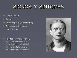 SIGNOS Y SINTOMAS
►   Tirotoxicosis
►   Bocio
►   Oftalmopatia ( exoftalmia)
►   Dermopatia ( edemas
    pretibiales)



►   Palpitaciones,nerviosismo y
    agitacion,piel caliente y
    humeda,diarrea,debilidad
    ,miopatia,intolerancia al
    calor,temblor,taquicardia
 