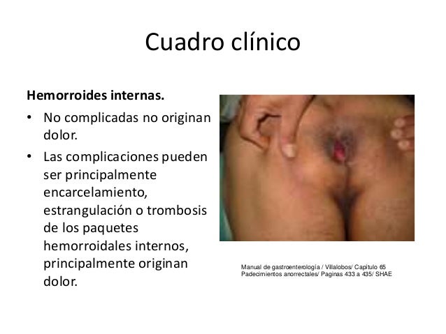 La complicación después de la operación la ampliación varicosa