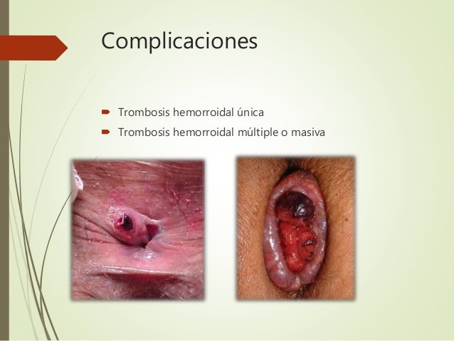 Enfermedad hemorroidal