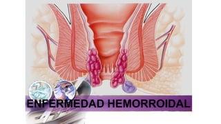 ENFERMEDAD HEMORROIDAL
 