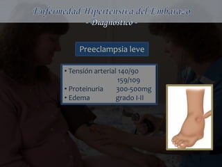 Preeclampsia leve

• Tensión arterial 140/90
                   159/109
• Proteinuria     300-500mg
• Edema           grado I-II
 