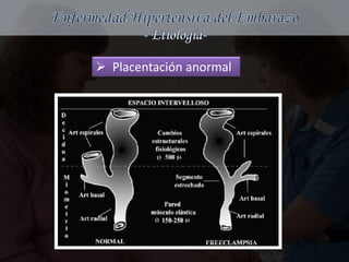  Placentación anormal
 