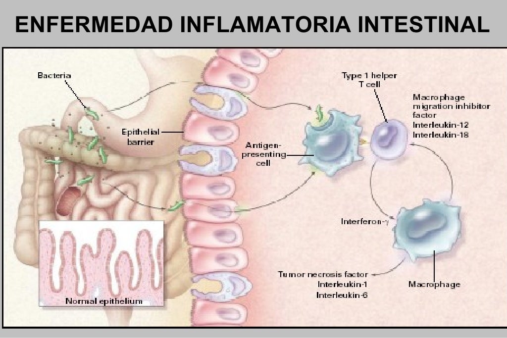Enfermedad inflamatoria intestinal