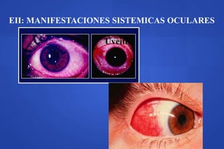 EII: MANIFESTACIONES SISTEMICAS OCULARES
Uveitis
 