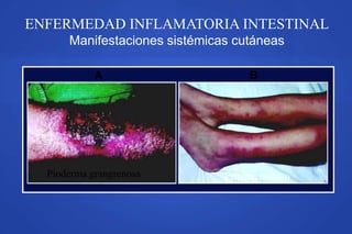 ENFERMEDAD INFLAMATORIA INTESTINAL
Manifestaciones sistémicas cutáneas
A B
Pioderma grangrenosa Eritema nodoso
 