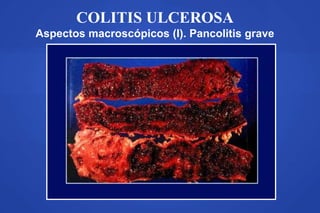 COLITIS ULCEROSA
Aspectos macroscópicos (I). Pancolitis grave
 