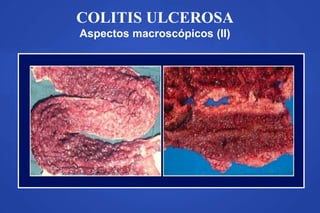 COLITIS ULCEROSA
Aspectos macroscópicos (II)
 