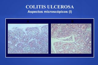 COLITIS ULCEROSA
Aspectos microscópicos (I)
A B
 