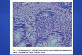 COLITIS ULCEROSA
Aspectos microscópicos (II)
A B
 