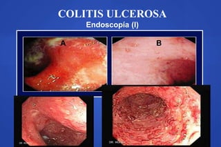 COLITIS ULCEROSA
Endoscopía (I)
A B
 