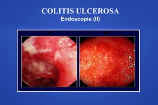 COLITIS ULCEROSA
Endoscopía (II)
A B
 