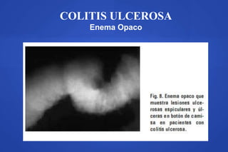 COLITIS ULCEROSA
Enema Opaco
A B
 