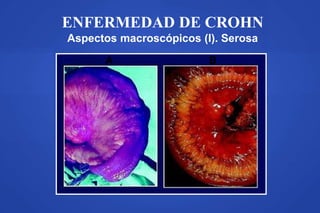 ENFERMEDAD DE CROHN
Aspectos macroscópicos (I). Serosa
A B
 