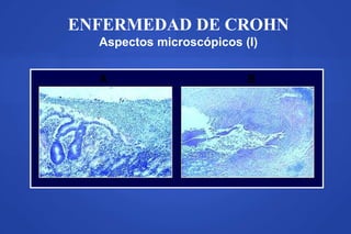 ENFERMEDAD DE CROHN
Aspectos microscópicos (I)
A B
 