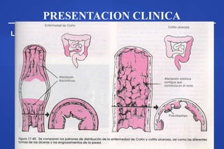 PRESENTACION CLINICA
La localización, extención y profundidad explica sintomatología
 