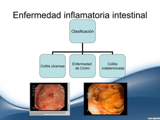 Enfermedad inflamatoria intestinal
Clasificación
Colitis ulcerosa
Enfermedad
de Crohn
Colitis
indeterminada
 