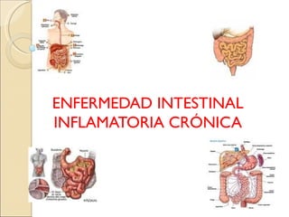 ENFERMEDAD INTESTINAL INFLAMATORIA CRÓNICA 
