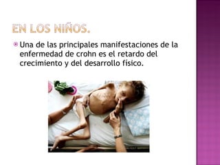 Una de las principales manifestaciones de la enfermedad de crohn es el retardo del crecimiento y del desarrollo físico. 