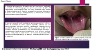 Caso Clínico
El paciente, varón de 4 años de edad y color de la piel mestizo, fue llevado
a consulta de estomatología por sus padres, en octubre de 2017. Al
interrogarlos, estos refirieron que el niño había presentado fiebre elevada
el día anterior y que al día siguiente ya aparecieron vesículas dolorosas en
la mucosa bucal, por las que el niño rechazaba los alimentos. El paciente se
mostró irritable y poco cooperativo.
El examen extraoral reveló vesícula de aproximadamente un milímetro
(mm) de diámetro en labio superior izquierdo, cubierta por una
pseudomembrana amarillenta, dolorosa a la palpación. El examen intraoral
constató la presencia de vesículas esféricas, solitarias, de 1-3 mm de
diámetro, tapizadas igualmente por una pseudomembrana amarillenta y
rodeadas de un halo eritematoso, situadas en el fondo del surco vestibular
derecho e izquierdo del labio inferior a la izquierda, mucosa de ambos
carrillos y borde lateral derecho de la lengua, extremadamente dolorosos a
la palpación.
Dra.Deyanira Cabrera Escobar; Medisur vol.16 no.3 Cienfuegos may.-jun. 2018
 