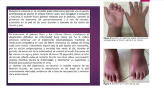 Durante la estancia en la consulta, pudo observarse además una erupción
acompañada de prurito en ambas manos y pies, que obligaban al pequeño
a rascarse, El examen físico general realizado por el pediatra, constató la
presencia de exantema, de aproximadamente 1-3 mm de tamaño,
extendido en la piel de las caras dorsales y laterales de los dedos de
manos y pies.
La anamnesis, el examen físico y los criterios clínicos, condujeron al
diagnóstico definitivo de enfermedad boca mano pie. Se le indicó
entonces continuar con el tratamiento estomatológico, mantener la
medicación antipirética en caso de fiebre, meclozina (½ tableta de 25mg
cada ocho horas), tratamiento tópico para la piel (baños con manzanilla,
por su acción antipruriginosa y secante) tres veces al día, durante el
período de evolución de la enfermedad; se orientó el lavado frecuente de
las manos con agua y jabón durante al menos 20 segundos, retirar al niño
del círculo infantil, evitar el contacto directo con otros niños, no compartir
objetos mientras durara la enfermedad, y desinfectar las superficies y
objetos que pudieran transmitir el virus.
Al séptimo día del diagnóstico, se observó la notable mejoría de las
lesiones bucales, así como la descamación en las áreas de la piel
anteriormente afectadas, evidencias de la fase de recuperación y remisión
de la enfermedad.
 