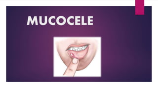 MUCOCELE
 