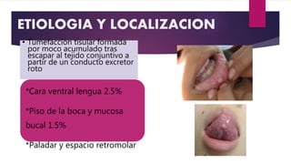ETIOLOGIA Y LOCALIZACION
*Labio inferior 96%
*Cara ventral lengua 2.5%
*Piso de la boca y mucosa
bucal 1.5%
*Paladar y espacio retromolar
• Tumefacción tisular formada
por moco acumulado tras
escapar al tejido conjuntivo a
partir de un conducto excretor
roto
 