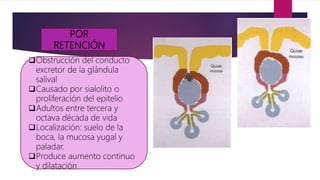 POR
RETENCIÓN
Obstrucción del conducto
excretor de la glándula
salival
Causado por sialolito o
proliferación del epitelio
Adultos entre tercera y
octava década de vida
Localización: suelo de la
boca, la mucosa yugal y
paladar.
Produce aumento continuo
y dilatación
 