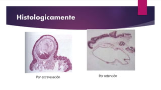Histologicamente
Por extravasación Por retención
 
